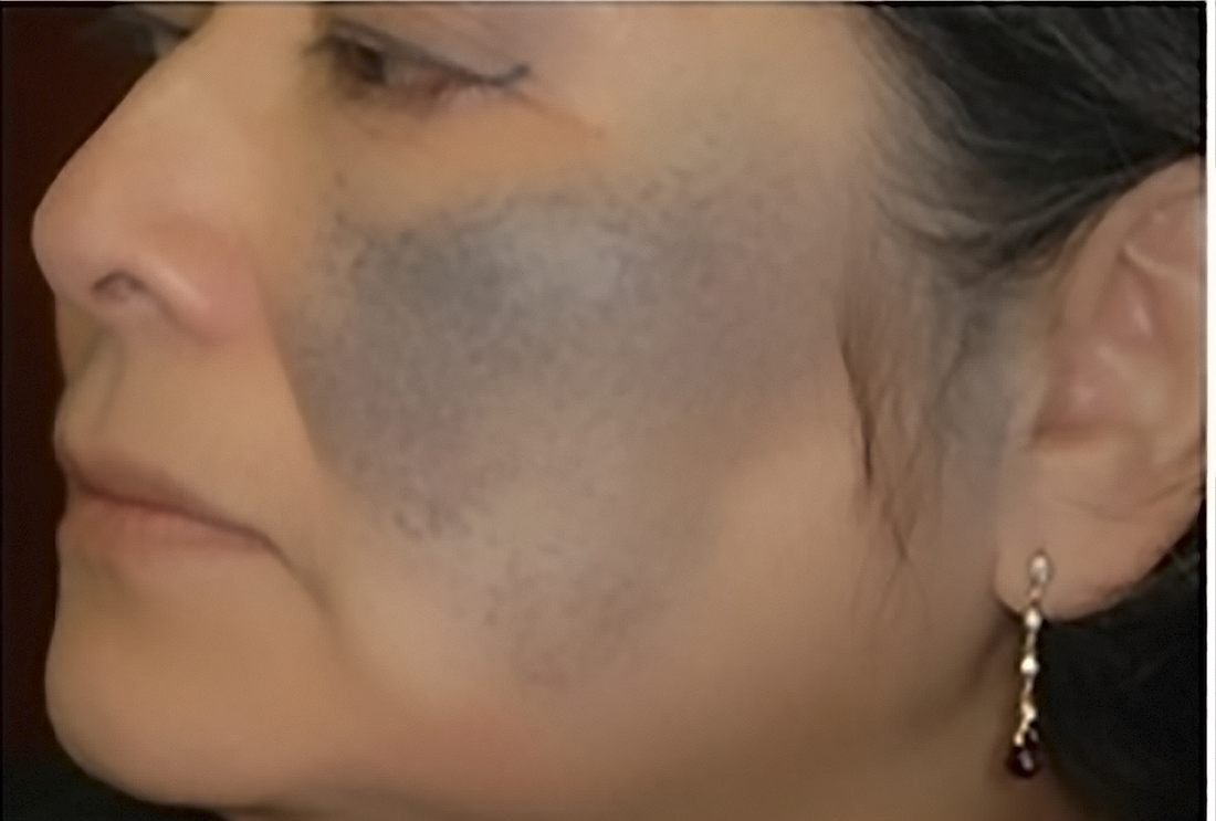 Mejilla con melasma antes del tratamiento