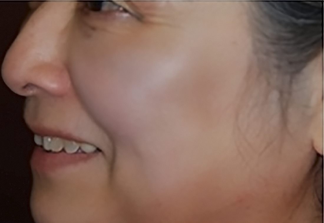 Mejilla después del tratamiento de melasma